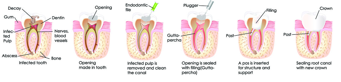 How A Root Canal Is Completed - Weber Dental Center - Spokane Valley WA