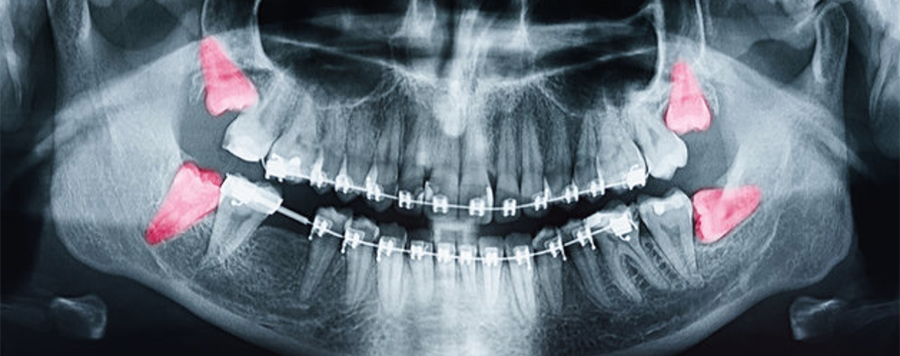 Digital Radiography  - Weber Dental Center - Spokane Valley WA